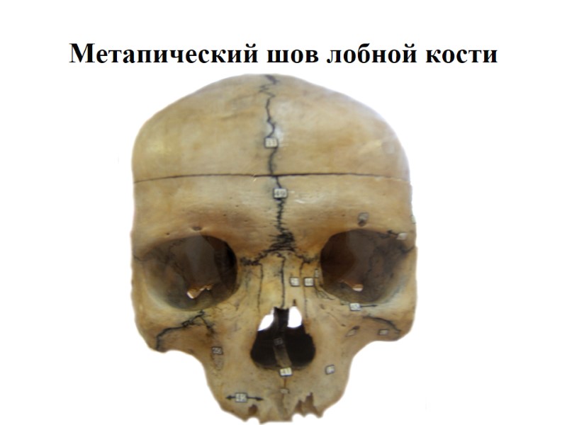 Метапический шов лобной кости